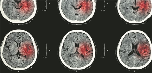 Intrakranielle Hämorrhagien traten in der Studie unter VKA früher auf als unter NOAK.