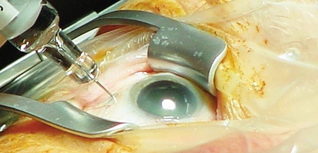 Zwischen Recht und Sparwahn Intravitreale Injektion: Der Streit um den VEGF-Hemmer Lucentis® (Ranibizumab) beschäftigt aktuell das Landgericht Hamburg.