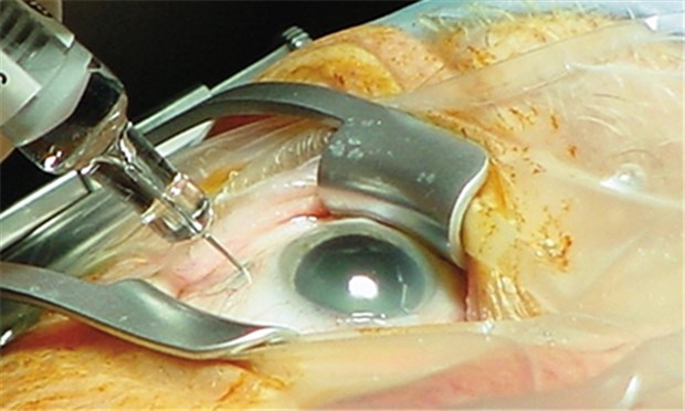 Drei Ersatzkassen ebnen Weg für Einsatz von Lucentis® Intravitreale Injektion bei einem Patienten mit feuchter Makula-Degeneration.