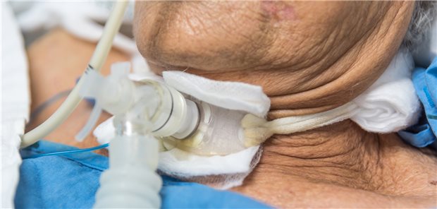 Invasive Beatmung über eine Trachealkanüle.
