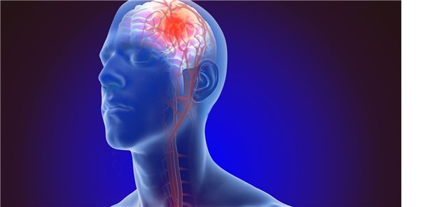 Ischämische Schlaganfälle werden häufig durch kardiale Embolien bei Vorhofflimmern ausgelöst: Nach dem Akutereignis ist die sekundärpräventive Antikoagulation angezeigt.