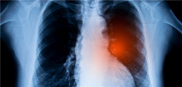 Ist Amivantamab eine starke Option für Patienten mit nicht-kleinzelligem Lungen-Ca? Der Hersteller sagt ja, der G-BA urteilt anders.