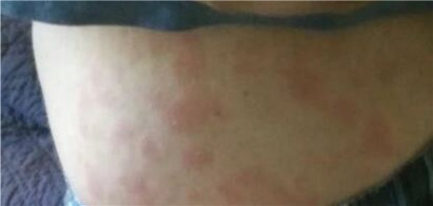 Ist das makulopapulöse Exanthem eine Impfreaktion oder mehr?