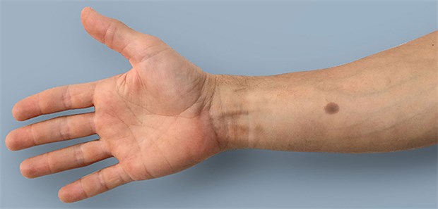 Künstlicher Leberfleck als Krebs-Frühwarnsystem Ist der Kalziumpegel im Blut über längere Zeit zu hoch, stösst ein unter der Haut eingesetztes Implantat die Produktion von Melanin an. Dadurch bildet sich dort ein Leberfleck (Bild nachgestellt).