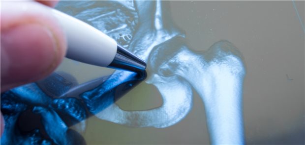 Ist die Hüfte intakt? Australische Wissenschaftler haben Warnsignale für Frakturen bei Älteren untersucht.