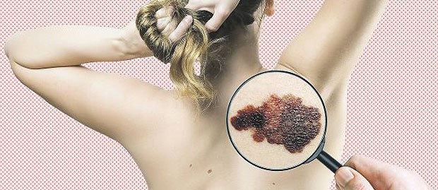 Ist ein Melanom bereits metastasiert, können Patienten von Vemurafenib profitieren.