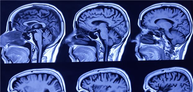Ist ein Schädel-Hirn-Trauma als chronische Erkrankung zu betrachten? Forschende Framingham Heart Study sprechen sich dafür aus.