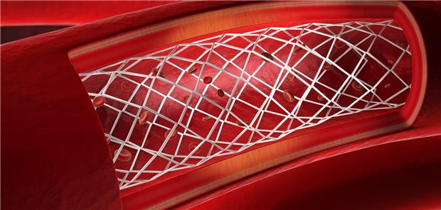 Ist ein Stent bei nicht komplexer Hauptstammstenose immer die optimale Lösung?