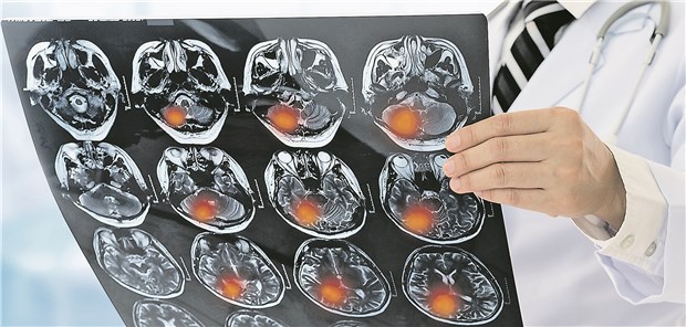 ISC 2019: Das ist neu in der Schlaganfalltherapie Ist es ein Schlaganfall? Ein Arzt analysiert den MRT-Scan eines Patienten. utah778/Getty Images/iStock