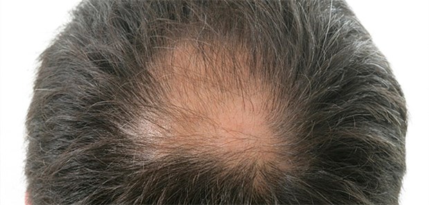 Neuer Ansatz, um Haarwachstum anzukurbeln Ist es eine Frage des Metabolismus in den Haaarfollikelzellen, wenn nicht mehr genug neue Haare produziert werden? Forschungsdaten legen das nahe.