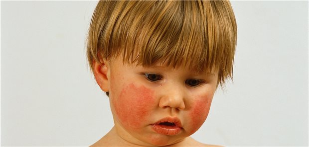 Ist es eine Nussallergie? Eine KI-gestützte App soll bald die frühzeitige Diagnostik in Arztpraxen unterstützen.