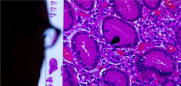 Todesfall wegen Fehldiagnose eines suchtkranken Arztes? Ist‘s die „richtige“ Gewebeprobe unter dem Mikroskop? Fehlerhafte Befunde eines Pathologen im Saarland sollen zu teils fatalen Folgen geführt haben.