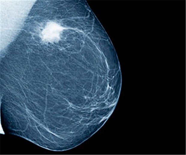 Brust brustkrebs sehr kleine Symptome früh