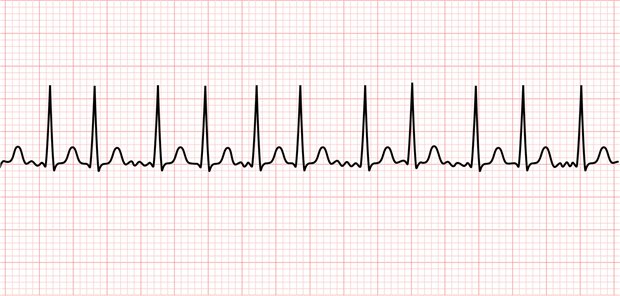 Je länger ein Vorhofflimmern besteht, desto größer das kardiovaskuläre Risiko. (Symbolbild)