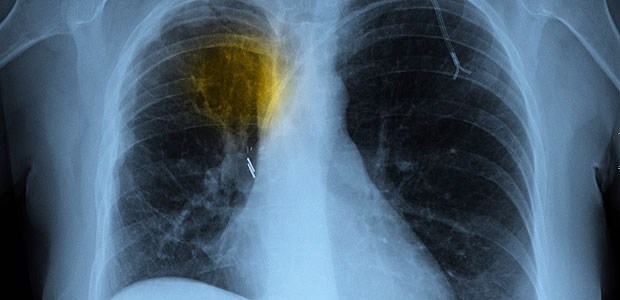 Bronchitis und Co. verstärken Krebsgefahr Je mehr entzündliche Lungenerkrankungen ein Mensch hatte, desto größer das Risiko für Lungenkrebs.
