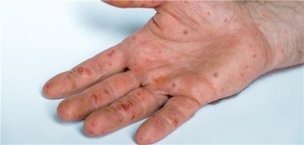 Je nach Entwicklungsphase äußert sich eine Mpox-Infektion anhand von flachen Läsionen, Bläschen, Pusteln oder doughnutförmigen Läsionen.&#xA;