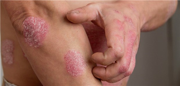 Jeder siebte Patient mit schwerer Psoriasis hatte in einer Studie eine fortgeschrittene Leberfibrose.