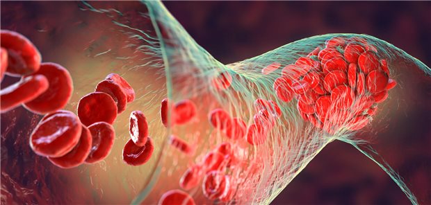 Johan Björklund und sein Team sind dafür die Thromboseprophylaxe nach einer Krebs-Operation besser auf den Einzelfall abzustimmen, da obwohl die Mehrzahl der thromboembolischen Ereignisse in der Phase aufgetreten seien, die von einer Standardprophylaxe abgedeckt werde, darüber hinaus oft ein deutlich erhöhtes Thromboserisiko bestehe. 