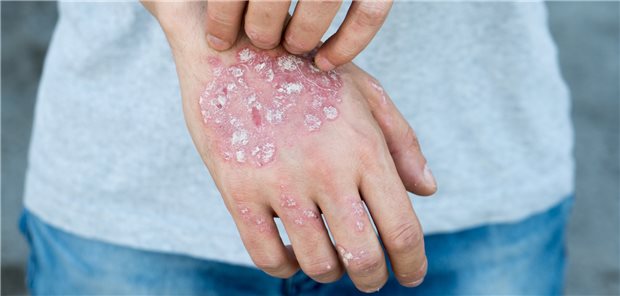 Juckendes Ekzem: Bei der Behandlung von Patienten mit Pustulöser Psoriasis ist mit Spesolimab eine neue Option verfügbar.