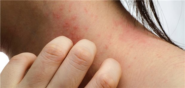 Juckreiz: Lästiges Symptom bei atopischer Dermatitis.