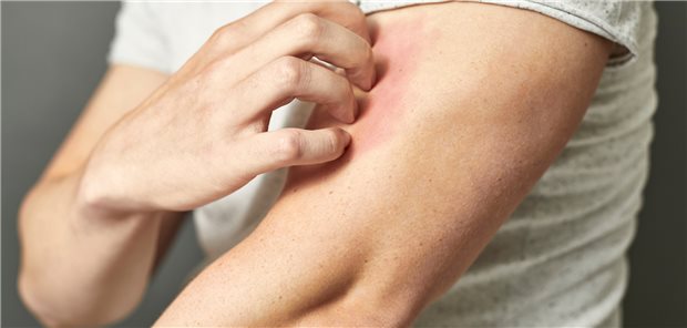 Juckreiz: Steckt tatsächlich eine Medikamentenallergie dahinter? Oder wurden Nebenwirkungen als Allergie fehlgedeutet?