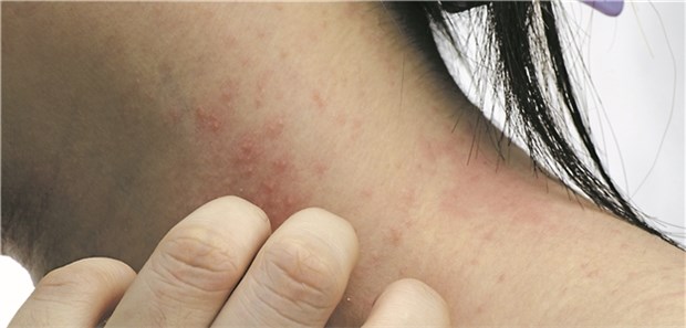 Ab wann systemisch behandeln? Juckreiz bei atopischer Dermatitis. Nicht immer reicht topische Therapie aus.