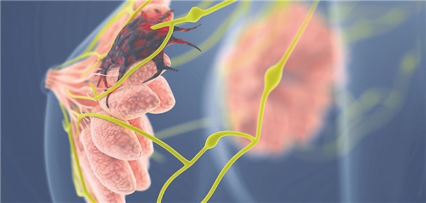 Jüngere Frauen mit Intervallkarzinomen zwischen zwei Mammografien haben ein höhres Risiko für eine schlechte Prognose als ältere Frauen.