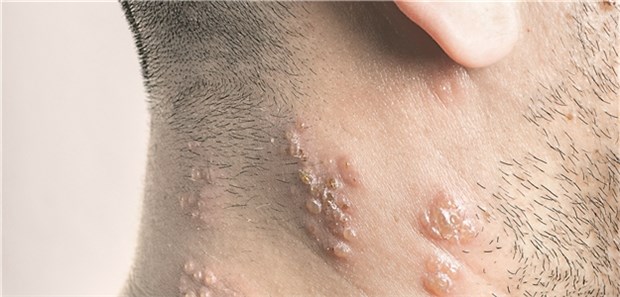 Krebspatienten haben ein erhöhtes Risiko Jüngere Krebspatienten sind den Studienergebnissen zufolge anfälliger für Herpes zoster als ältere.