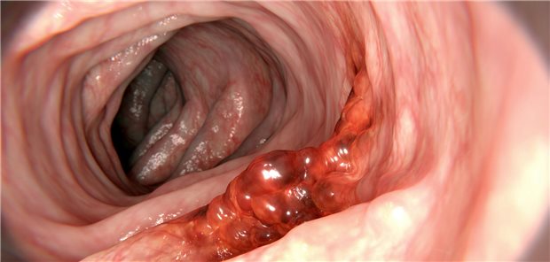 Jüngere Patientinnen und Patienten mit Darmkrebs weisen häufiger höhere Stadien und damit eine ungünstigere Prognose auf als ältere, hieß es beim Deutschen Krebskongress.