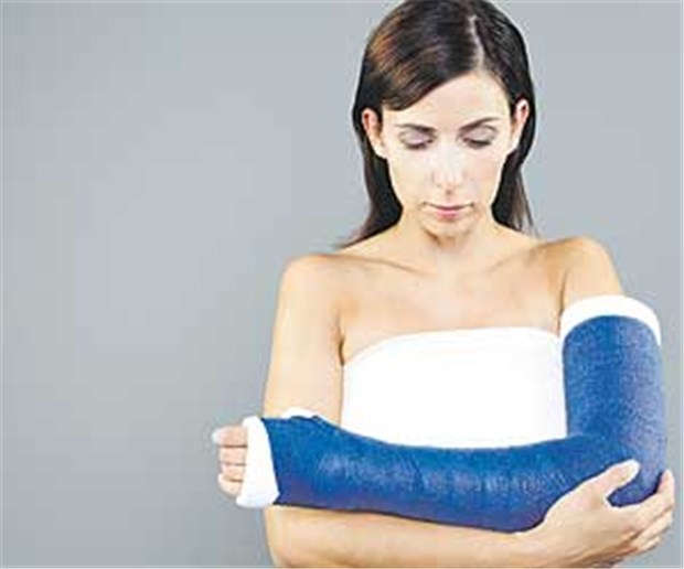 Ein Gipsarm verändert das Gehirn Junge Frau mit Gipsarm: Es erfolgt ein rascher Umbau des Nervensystems.