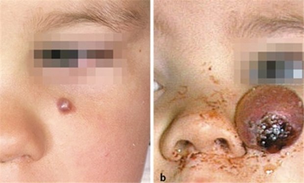 Wenn die Haarmatrix Amok läuft Junge mit einem zu Beginn 0,5 cm großen Nodus. Bereits zwei Monate später zeigte sich ein 2,5 x 2,5 cm großer, teils exulzerierter Tumor.