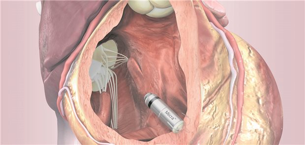 Kabelloser Herzschrittmacher: Das Micra-System wird im rechten Ventrikel verankert. Sind in Zukunft Devices denkbar, für die das Herz selbst die Energie zum Betrieb liefert?