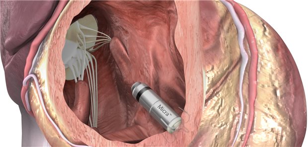 Kabelloser Herzschrittmacher: Das Micra-System wird per steuerbarem Katheter in den rechten Ventrikel vorgeschoben und dort verankert.