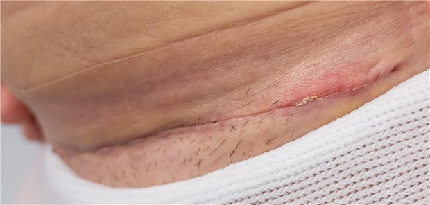 Nahaufnahme einer Kaiserschnittsnarbe, noch in Krankenhausunterwäsche