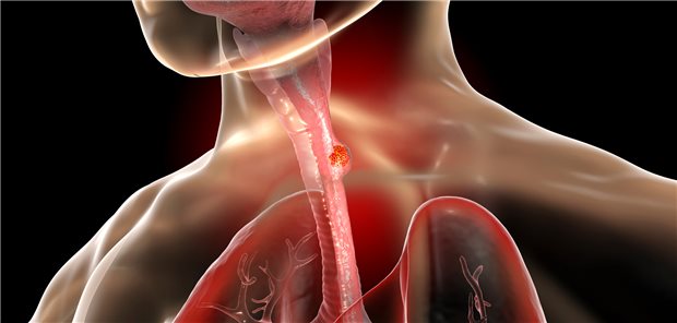 Kann der PD-1-Hemmer Serplulimab eine Lücke in der Therapie bei Personen mit fortgeschrittenem Plattenepithelkarzinom des Ösophagus schließen?