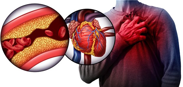 Compuerillustration einer Person, die sich an die Brust greift; darüber vergrößert das Herz und nochmals vergrößert darüber die Darstellung einer Thrombusbildung.