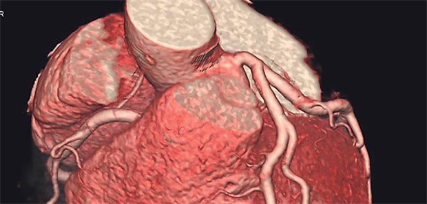 CT-Angiografie schon reif für die KHK-Erstliniendiagnostik? Kardio-CT: Durch verbesserte räumliche Auflösung können auch kleinere Strukturen der Koronaranatomie gut erkannt werden.