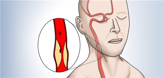 Karotisstenose: Das Schlaganfallrisiko hängt vom Grad der Stenose ab.