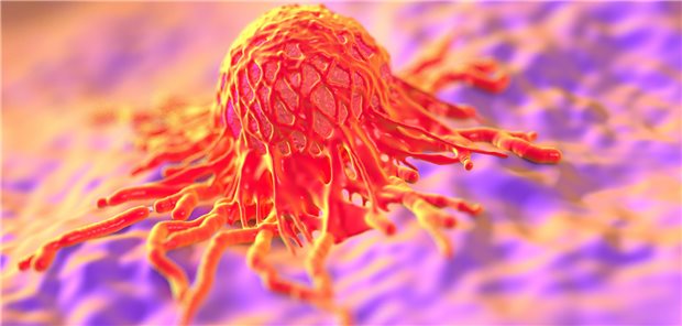 Karzinom: An der Entstehung von Krebszellen scheinen Darmbakterien beteiligt zu sein, berichten chinesische Forscher.