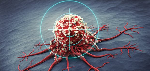 Karzinom im Visier: Auf die Therapie mit Idecabtagene Vicleucel sprachen in einer US-Studie 71 Prozent der Teilnehmer mit Multiplem Myelom an.
