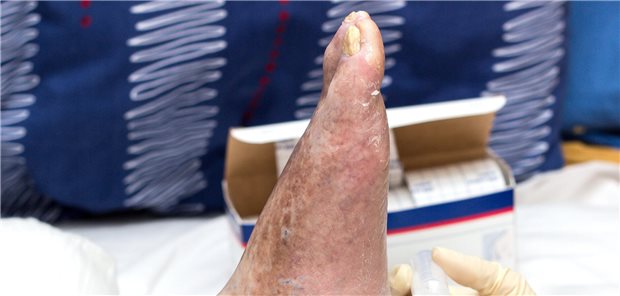 Person mit diabetischem Fußsyndrom