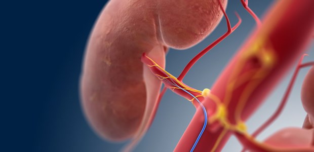 'Denervation nur noch in Studien' Katheter auf dem Weg zur Nierennervenarterie - ohne signifikanten Unterschied zum Placebo in der SYMPLICITY HTN-3-Studie.