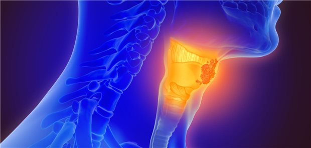 Kehlkopfkrebs: Betroffene Personen erkrankten in einer Studie am häufigsten an erneuten Primärtumoren. (Symbolbild)