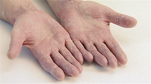 Kontaktekzem bei Psoriasis - das ist selten Kein Kontaktekzem, sondern Schuppenflechte (Psoriasis).