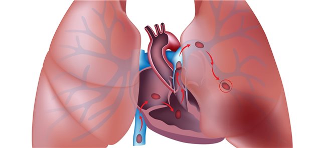 Eine Lungenembolie ist wohl bei COPD-Patienten nicht selten die Ursache von Symptomen wie Brustschmerz, Atemnot und Rechtsherzversagen.