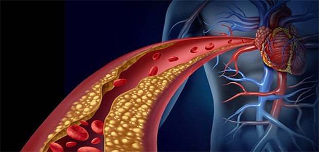 Ist selbst "normales" LDL-Cholesterin schädlich? Keine offensichtlichen Risikofaktoren und trotzdem kardiovaskuläre Ereignisse? Offenbar können auch bei solchen Patienten Gefäßablagerungen durch LDL-Cholesterin vorliegen.