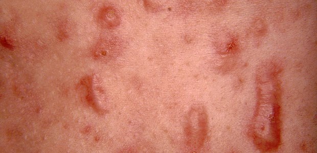 Eiszeit für Narben Keloid-Akne.