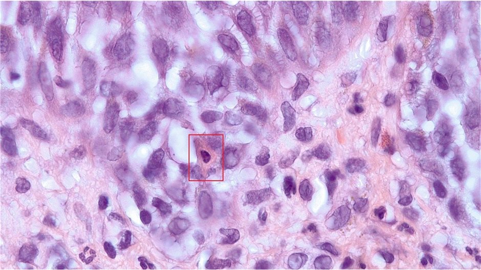 Keratinozytennekrosen im Sinne von Dyskeratosen (roter Kasten)
