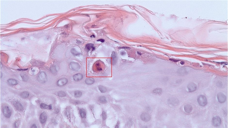Keratinozytennekrosen im Sinne von Dyskeratosen (roter Kasten) in unterschiedlic...