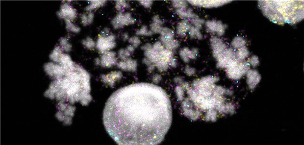 Kerne und Chromosomen von Neuroblastomzellen: DNA-Ringe sind gelb, türkis oder magenta angefärbt. Jede Farbe signalisiert unterschiedliche Krebsgene. In der vorliegenden Studie wurden große DNA-Ringe in vielen Neuroblastomzellen gefunden, – vermutet wird, dass sie das Zellwachstum antreiben.